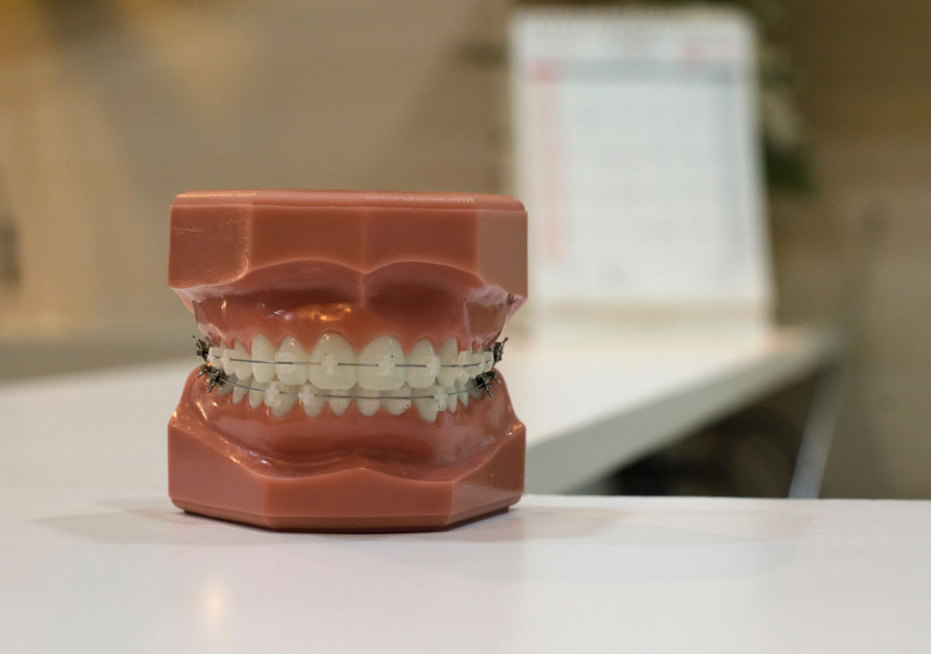 Dentures wearing braces on a formica table